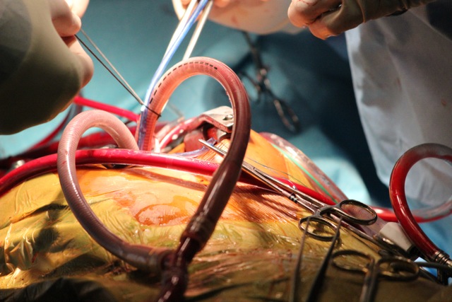 the multitude of tubes used during surgery