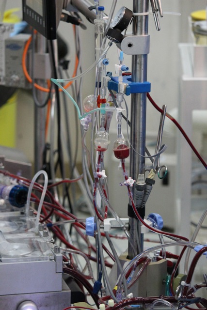 the heart lung machine in action in PNG